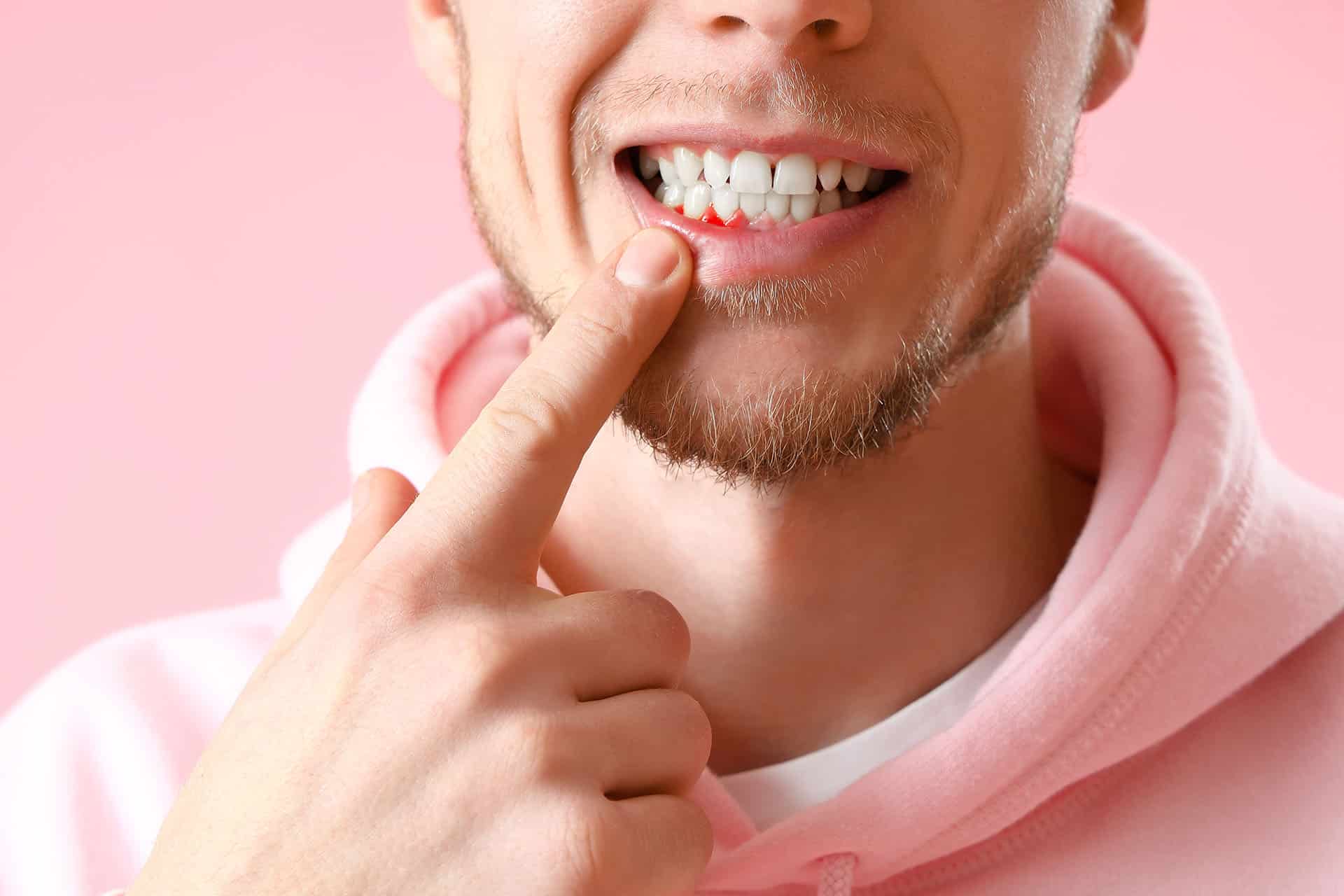Gingivitis — Zahnfleischentzündung