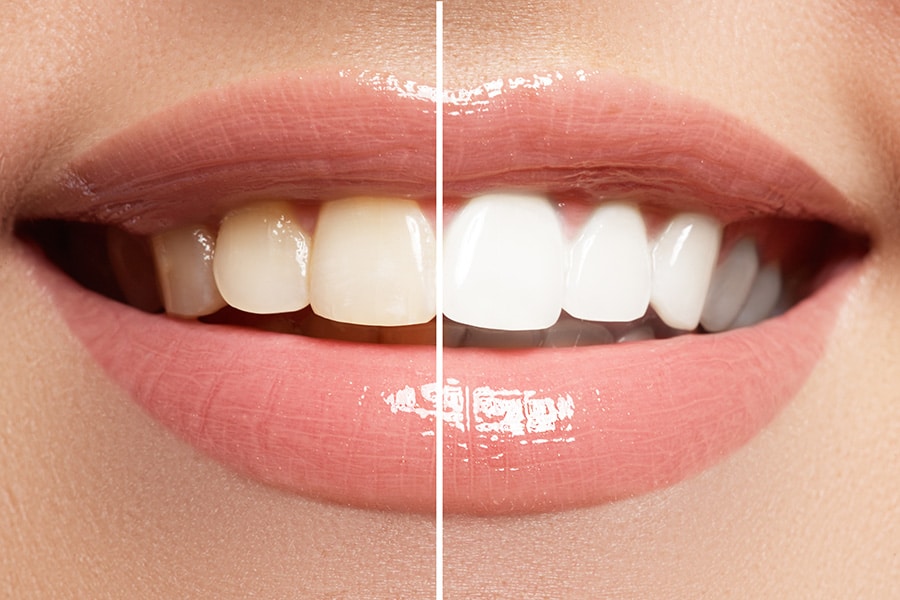 Ergebnis nach unsichtbarer Zahnspange und Bleaching