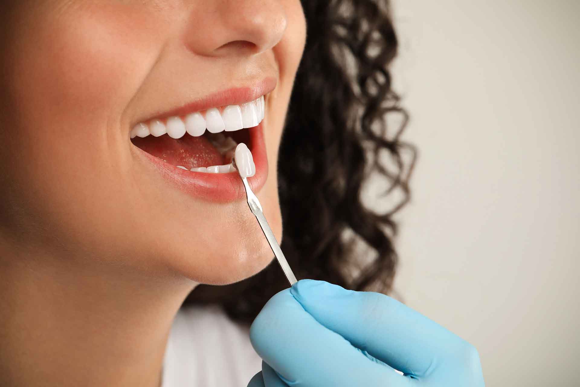 Veneers als ästhetische Lösung bei Zahnfleischrückgang